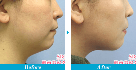 Aquicell アキーセル 脂肪吸引 脂肪吸引なら湘南美容クリニック 公式