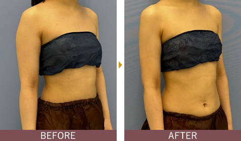 アキーセル脂肪吸引 二の腕の症例