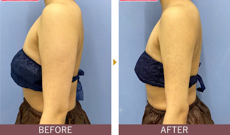 アキーセル脂肪吸引 二の腕の症例