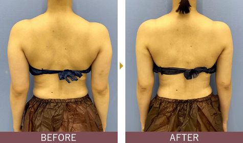 アキーセル脂肪吸引 二の腕の症例