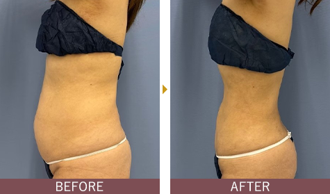 アキーセル脂肪吸引 お腹の症例