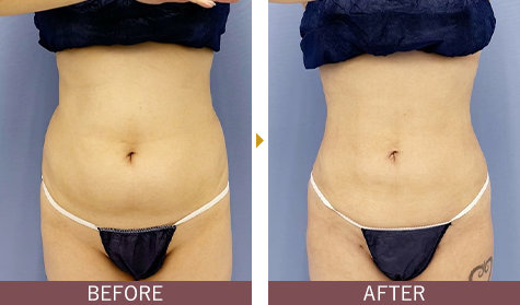 アキーセル脂肪吸引 お腹の症例