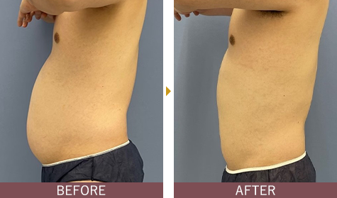 アキーセル脂肪吸引 お腹の症例