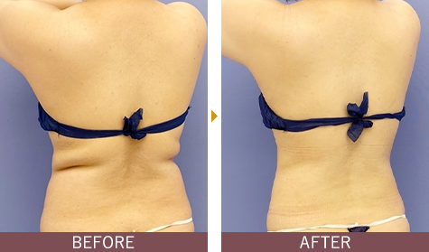 アキーセル脂肪吸引 お腹の症例