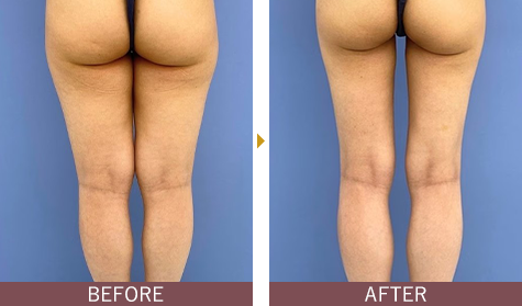 アキーセル脂肪吸引 太ももの症例