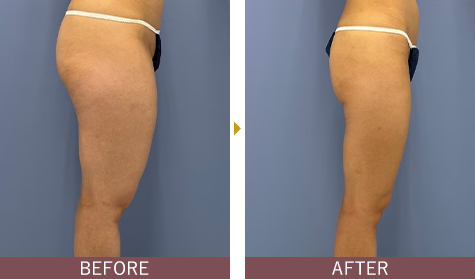 アキーセル脂肪吸引 太ももの症例