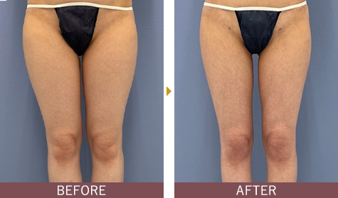 アキーセル脂肪吸引 太ももの症例