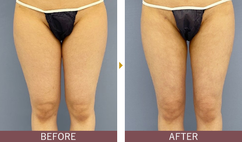 Aquicell（アキーセル）脂肪吸引｜脂肪吸引なら湘南美容クリニック【公式】