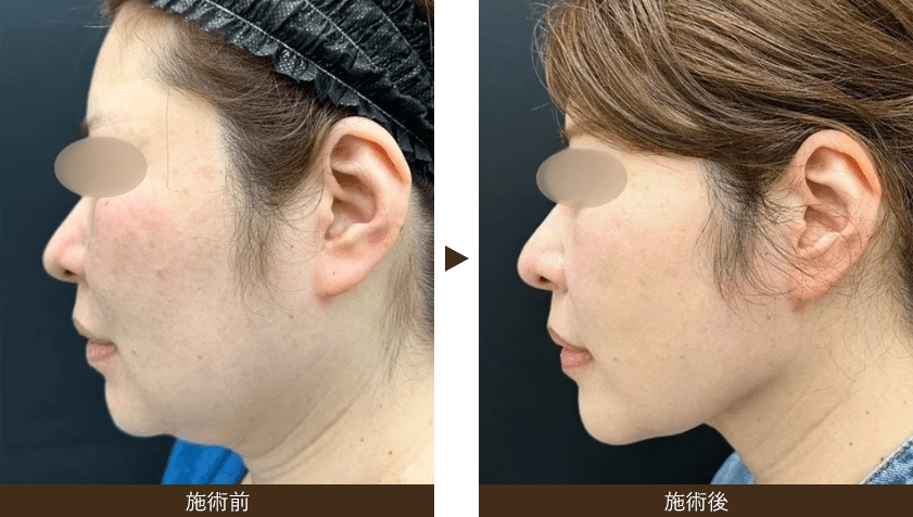 美ボディ脂肪吸引 フェイスライン（アゴ下＋エラ下）の症例画像