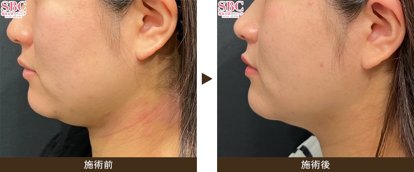 美ボディ脂肪吸引（頬+アゴ下+ジョールファット）の症例画像