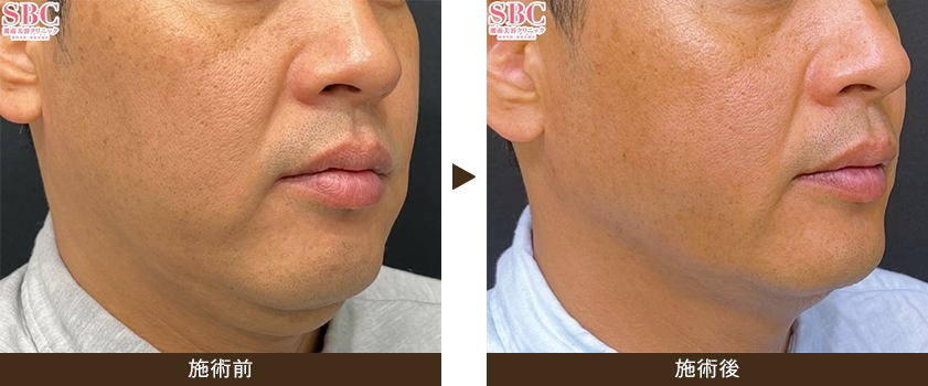 美ボディ脂肪吸引（頬+アゴ下+ジョールファット）の症例画像