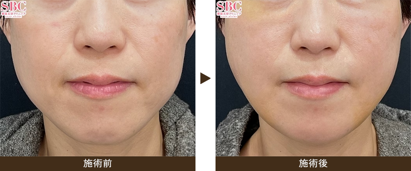 美ボディ脂肪吸引（頬+ジョールファット）の症例画像