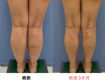 ふくらはぎの症例写真03