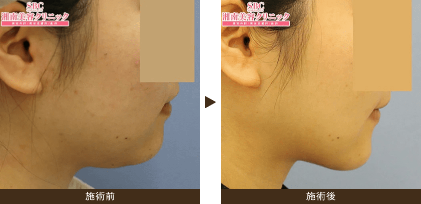 美ボディ脂肪吸引 脂肪吸引なら湘南美容クリニック 公式