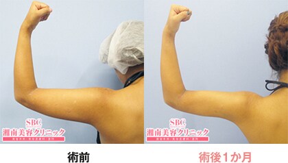 美ボディ脂肪吸引 脂肪吸引なら湘南美容クリニック 公式