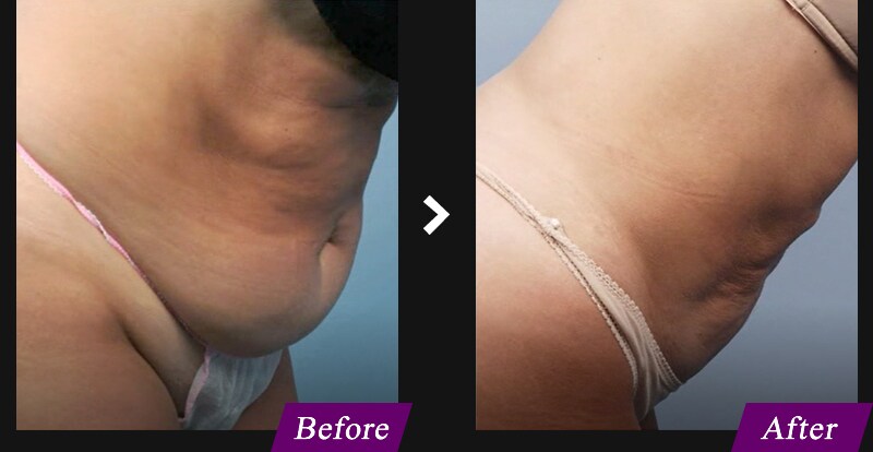 エンブレイスRF（フェイスタイト/ボディタイト）　腹部の症例写真　before after