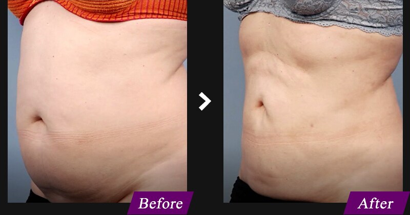 エンブレイスRF（フェイスタイト/ボディタイト）　腹部の症例写真　before after