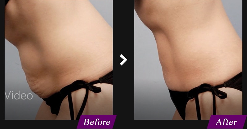 エンブレイスRF（フェイスタイト/ボディタイト）　腹部の症例写真　before after