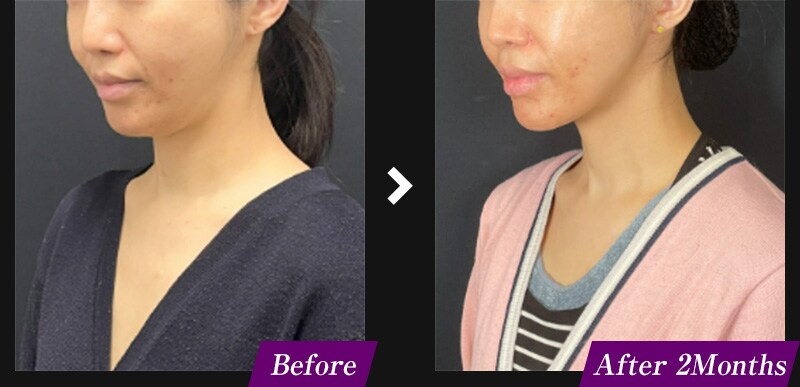 エンブレイスRF（フェイスタイト/ボディタイト）　アゴ下の症例写真　before after