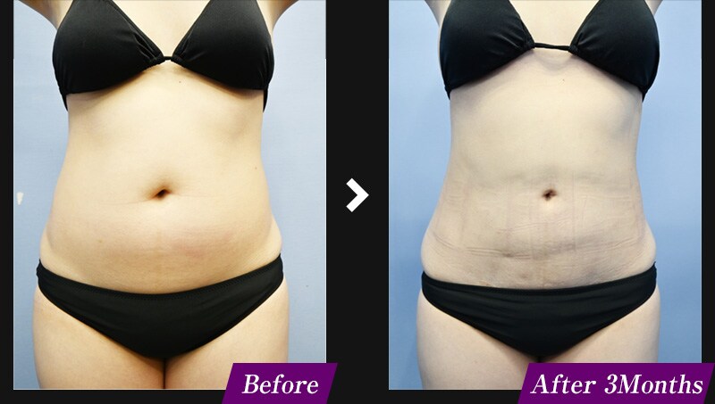 エンブレイスRF（フェイスタイト/ボディタイト）　腹部の症例写真　before after