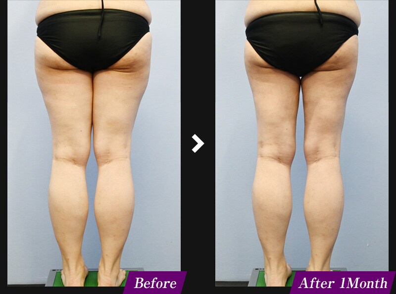 エンブレイスRF（フェイスタイト/ボディタイト）　腹部の症例写真　before after