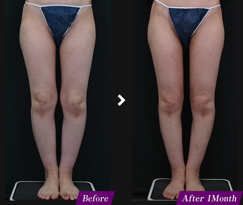 エンブレイスRF（フェイスタイト/ボディタイト）　腹部の症例写真　before after