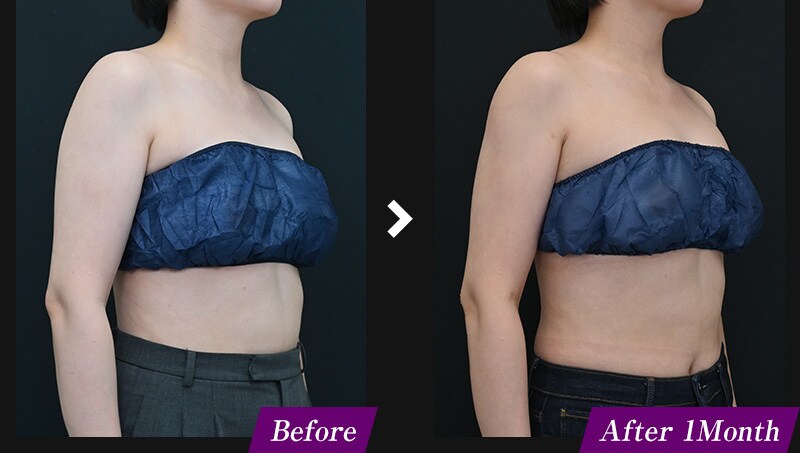 エンブレイスRF（フェイスタイト/ボディタイト）　二の腕の症例写真　before after