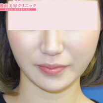 顔の脂肪吸引 症例写真　アフター