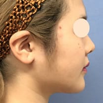 顔の脂肪吸引 症例写真　アフター 