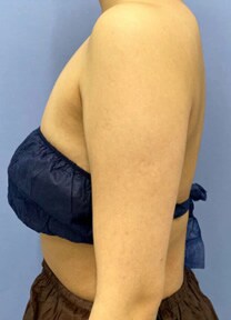 二の腕の脂肪吸引　症例写真　ビフォー