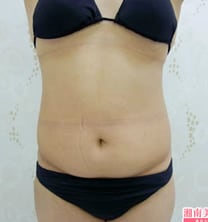 お腹の脂肪吸引　症例写真　ビフォー