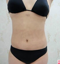 お腹の脂肪吸引　症例写真　アフター