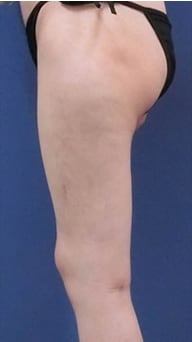 下半身の脂肪吸引　症例写真　アフター
