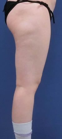 下半身の脂肪吸引　症例写真　ビフォー