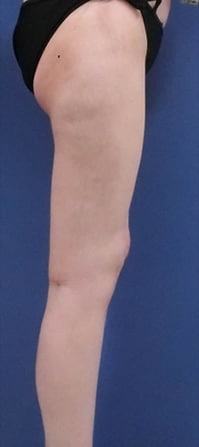 下半身の脂肪吸引　症例写真　アフター