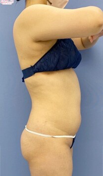 お腹の脂肪吸引　症例写真　ビフォー