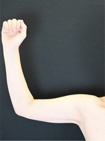二の腕の脂肪吸引　症例写真　アフター