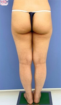 下半身の脂肪吸引　症例写真　ビフォー