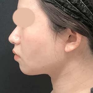 根こそぎVASER脂肪吸引 他
