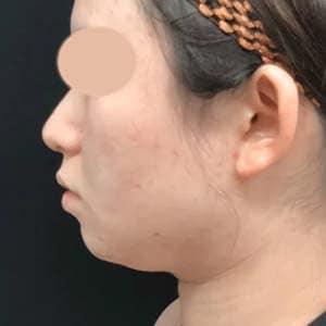根こそぎVASER脂肪吸引 他