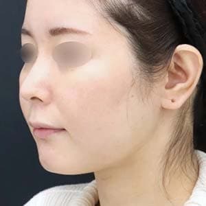Aquicell（アキーセル）脂肪吸引 他