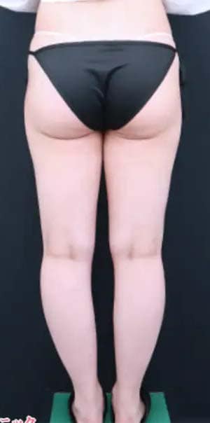 ベイザー併用アキーセル脂肪吸引