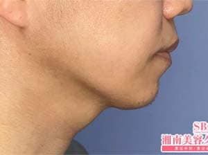 美ボディ脂肪吸引