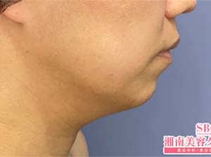 美ボディ脂肪吸引