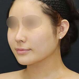 美ボディ脂肪吸引