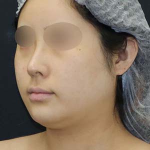 美ボディ脂肪吸引