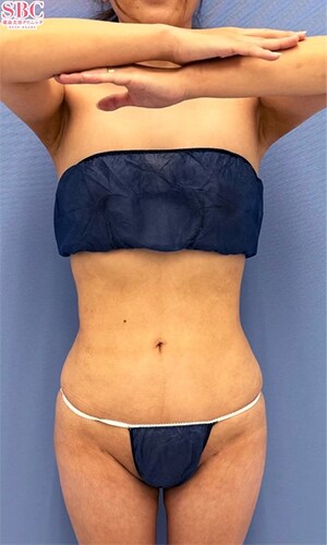 Aquicell（アキーセル）脂肪吸引 他