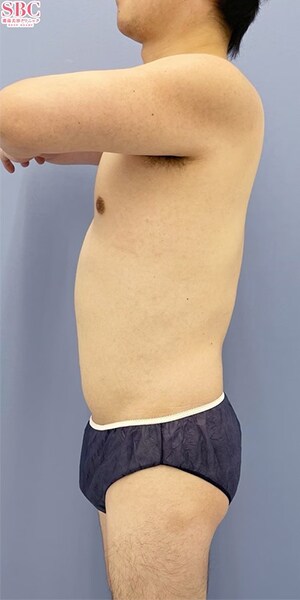 Aquicell（アキーセル）脂肪吸引 他