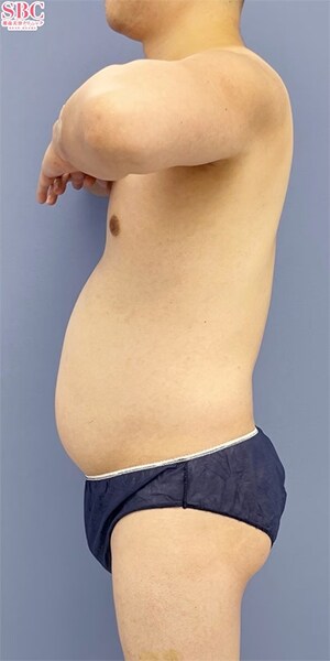 Aquicell（アキーセル）脂肪吸引 他