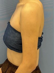 二の腕の脂肪吸引　症例写真　アフター